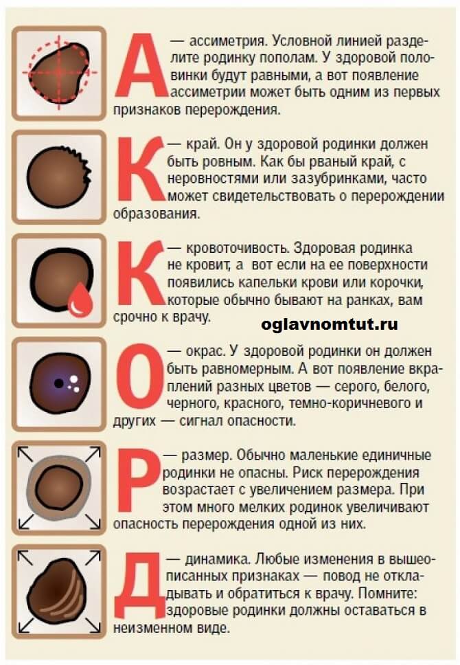 Родинки у детей: 120 фото и видео инструкция как проверить родинку на онкологию