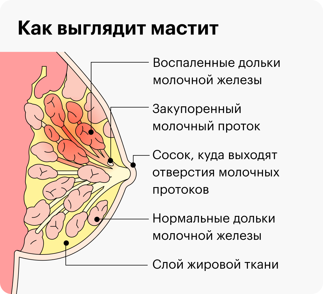 Лактостаз при грудном вскармливании