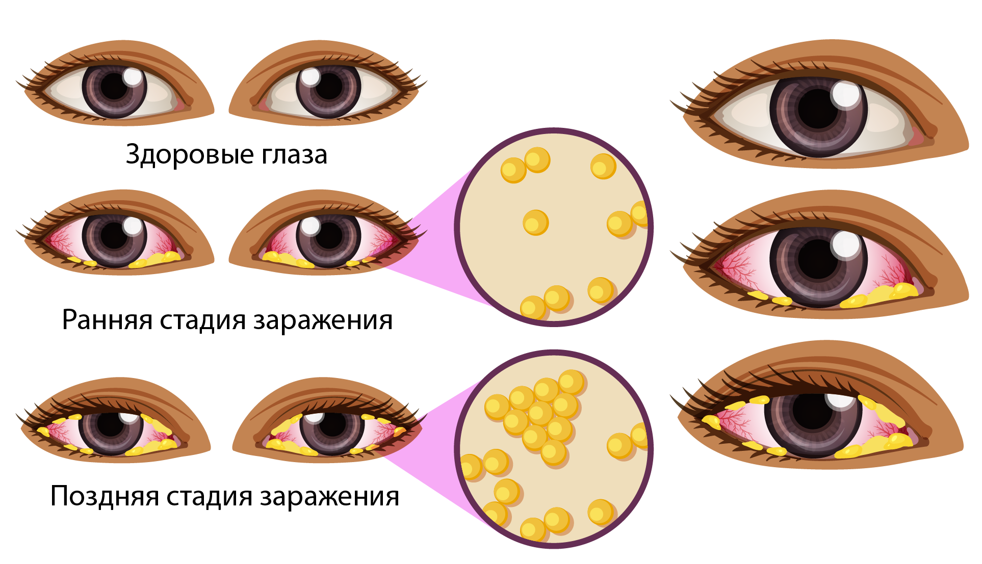 Как лечить конъюнктивит у кормящей мамы