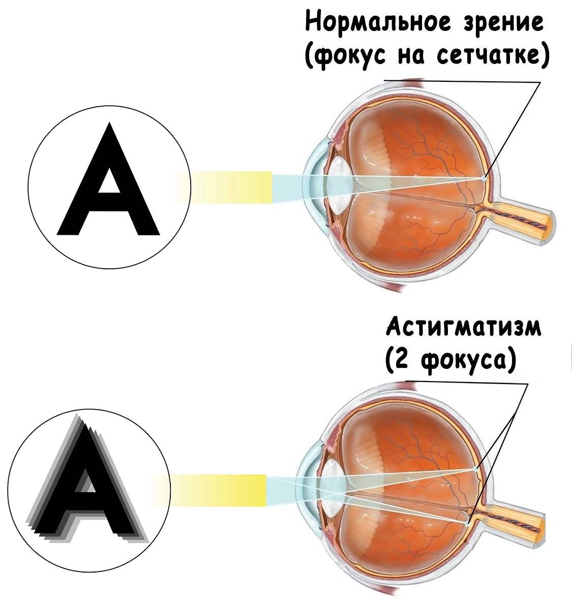 Астигматизм у детей – лечение и диагностика в клинике fedorovmedcenter