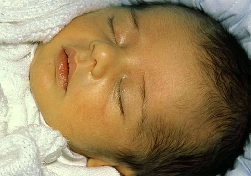 Младенческая желтуха: симптомы, методы лечения, последствия для новорожденных