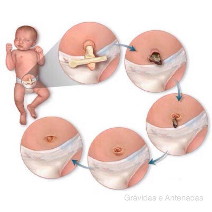 Пупочная грыжа у новорожденных детей: фото, лечение, симптомы