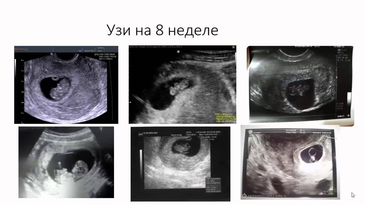 8 недель и 4 дня. УЗИ на 8 неделе беременности акушерской. 8 Недель беременности фото эмбриона. 8 Я акушерская неделя УЗИ. Как выглядит плод в 8 недель на УЗИ.