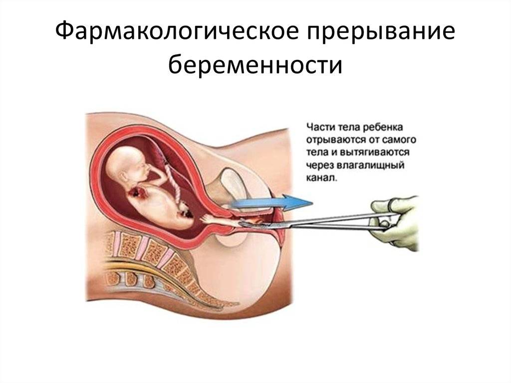 Может ли наступить беременность после аборта: секреты беременности