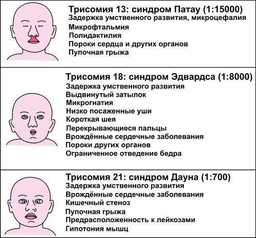 Можно ли излечить синдром патау у ребёнка?