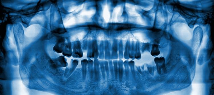 Можно ли во время беременности делать рентген зуба, какие могут быть последствия?