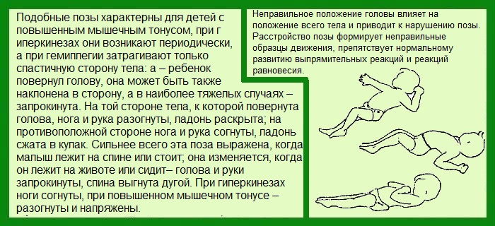 Кривошея у новорожденных: признаки у грудничка в 3 месяца, как исправить, основные симптомы