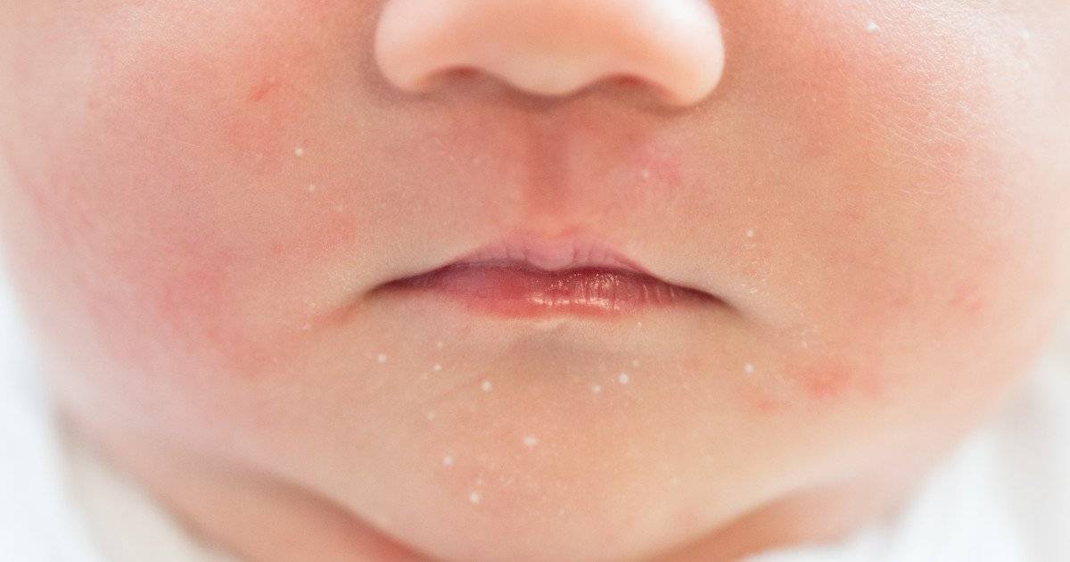Сыпь на лице у грудничка: ее разновидности, причины и лечение