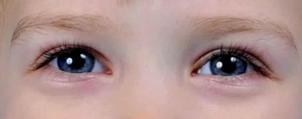 12 частых причин появления синяков под глазами у ребёнка