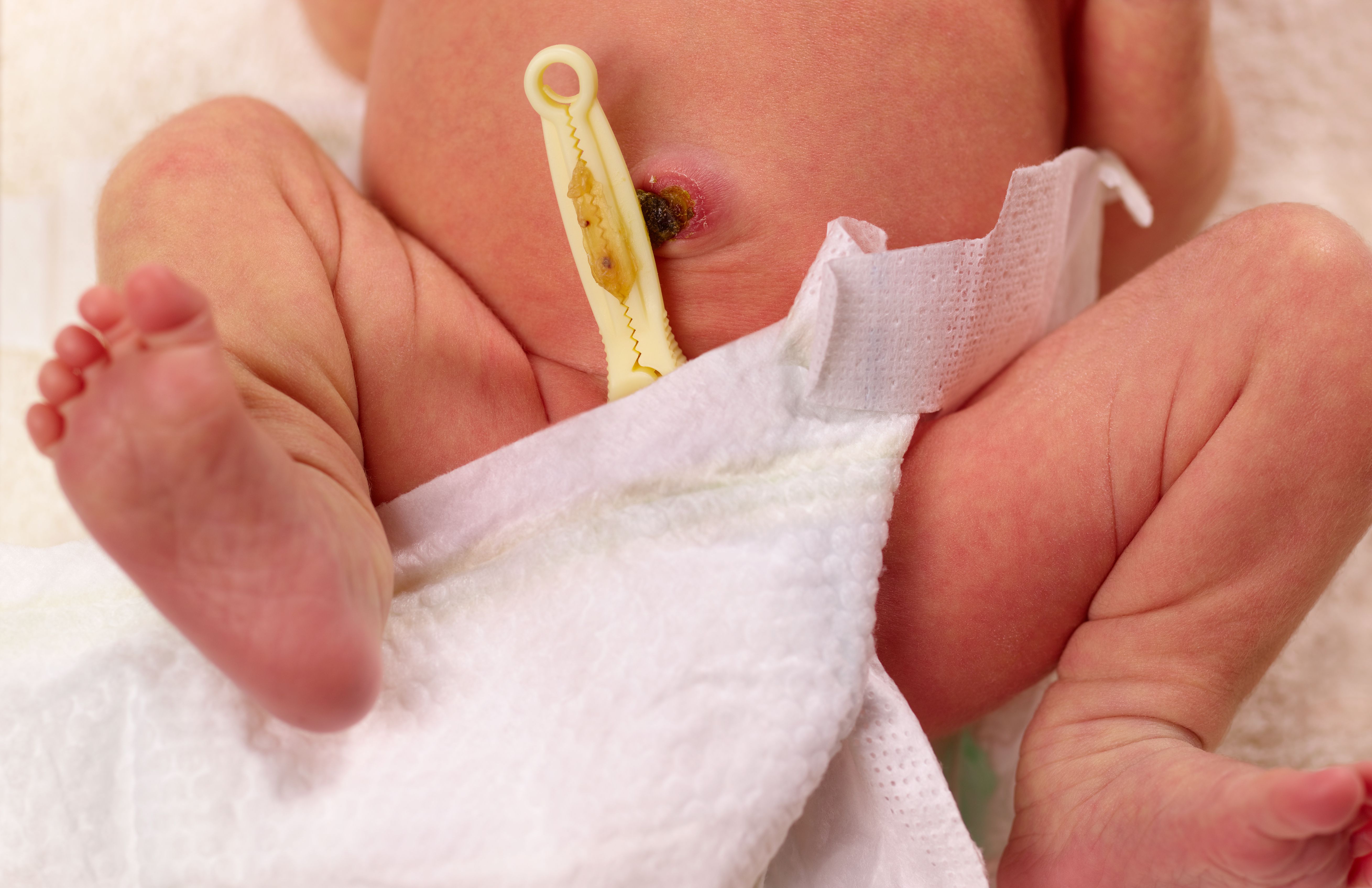 Кровит пупок у новорожденного: почему это происходит, что делать