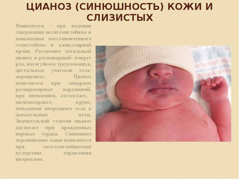 Синеет носогубный треугольник у грудничка: причины цианоза у ребенка (комаровский) | konstruktor-diety.ru