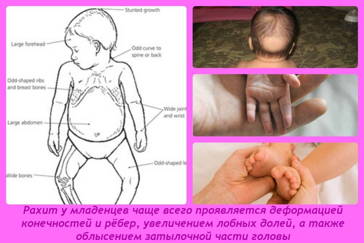 Признаки и профилактика рахита у грудничка