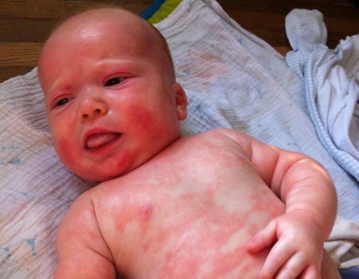 Токсическая эритема новорожденных: причины, лечение и последствия | terra-baby.ru