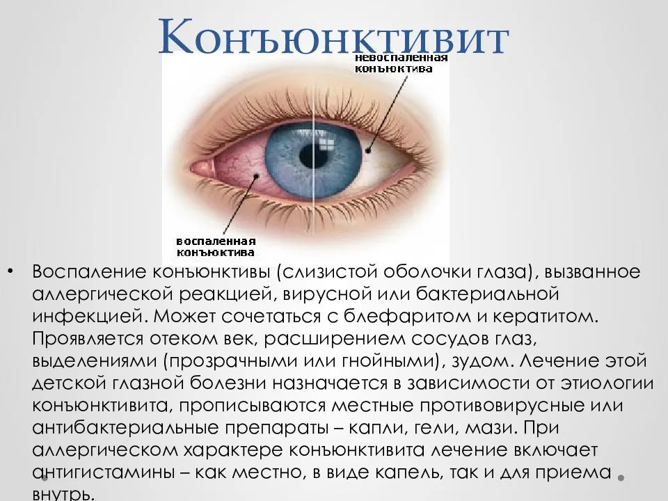Гноятся глаза у ребенка чем лечить народными средствами