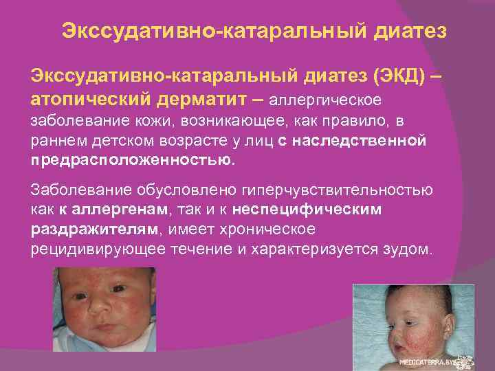 Экссудативно-катаральный диатез:причины, симптомы, лечение