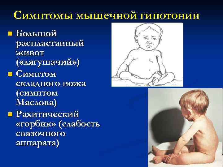 Пониженный тонус мышц (гипотонус) у детей