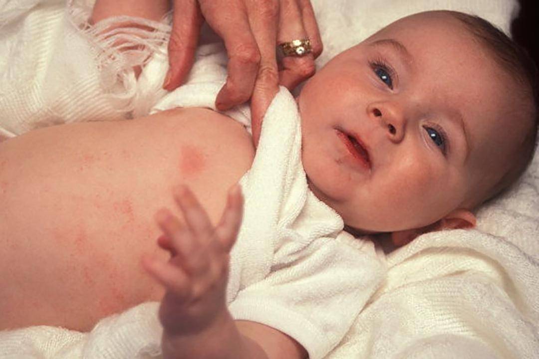 Эритема новорожденных: токсическая и физиологическая формы, фото, причины и лечение