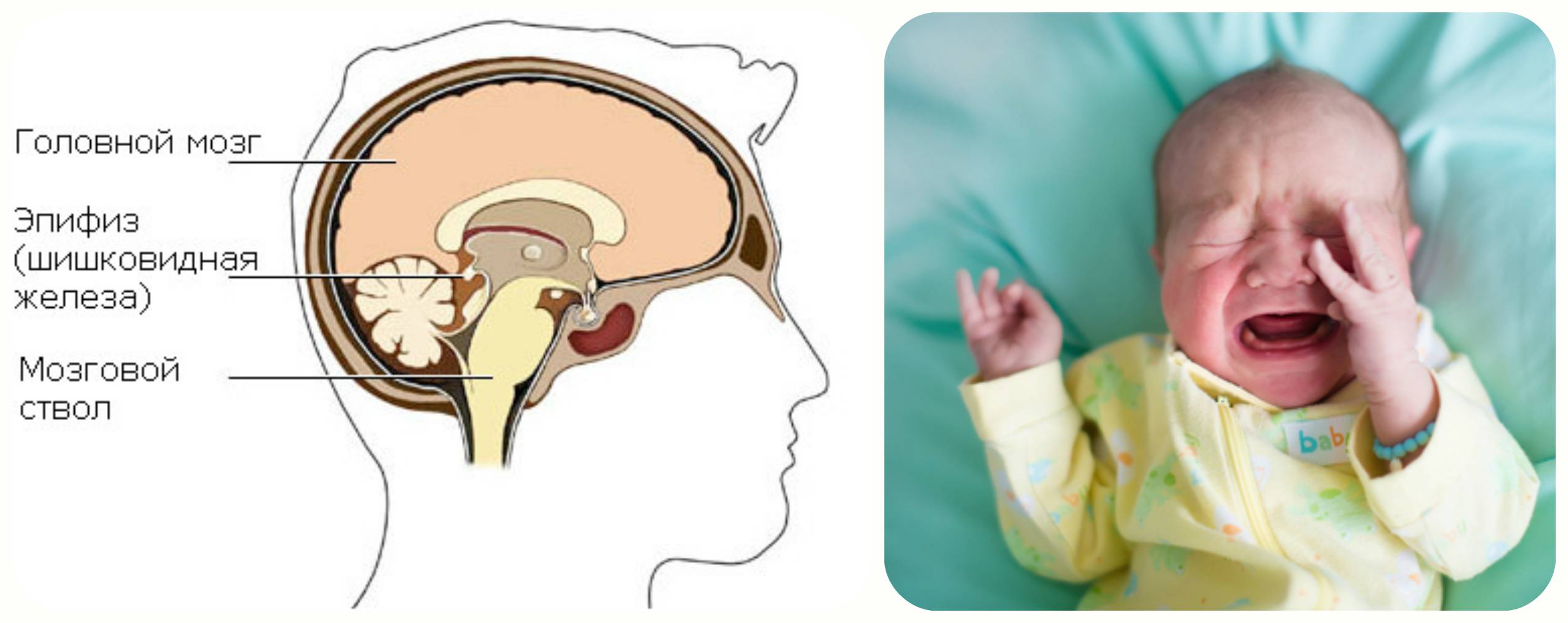 Особенности псевдокисты головного мозга у новорожденного
