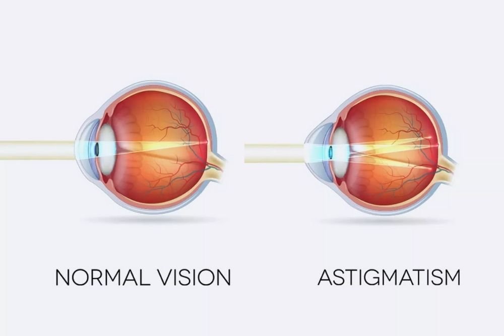 Что такое сложный миопический астигматизм. Строение глаза астигматизм. Астигматизм картинки. Что такое астигматизм зрения. Астигматизм и нормальное зрение.