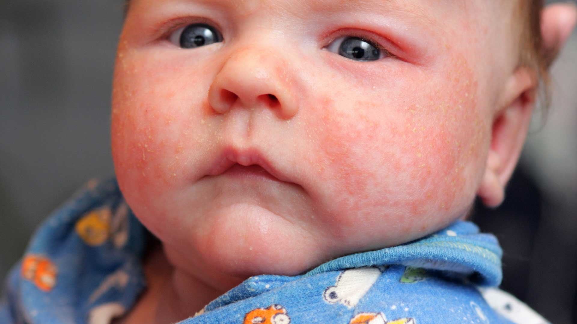 Сыпь у новорожденных и грудных детей (+фото)
