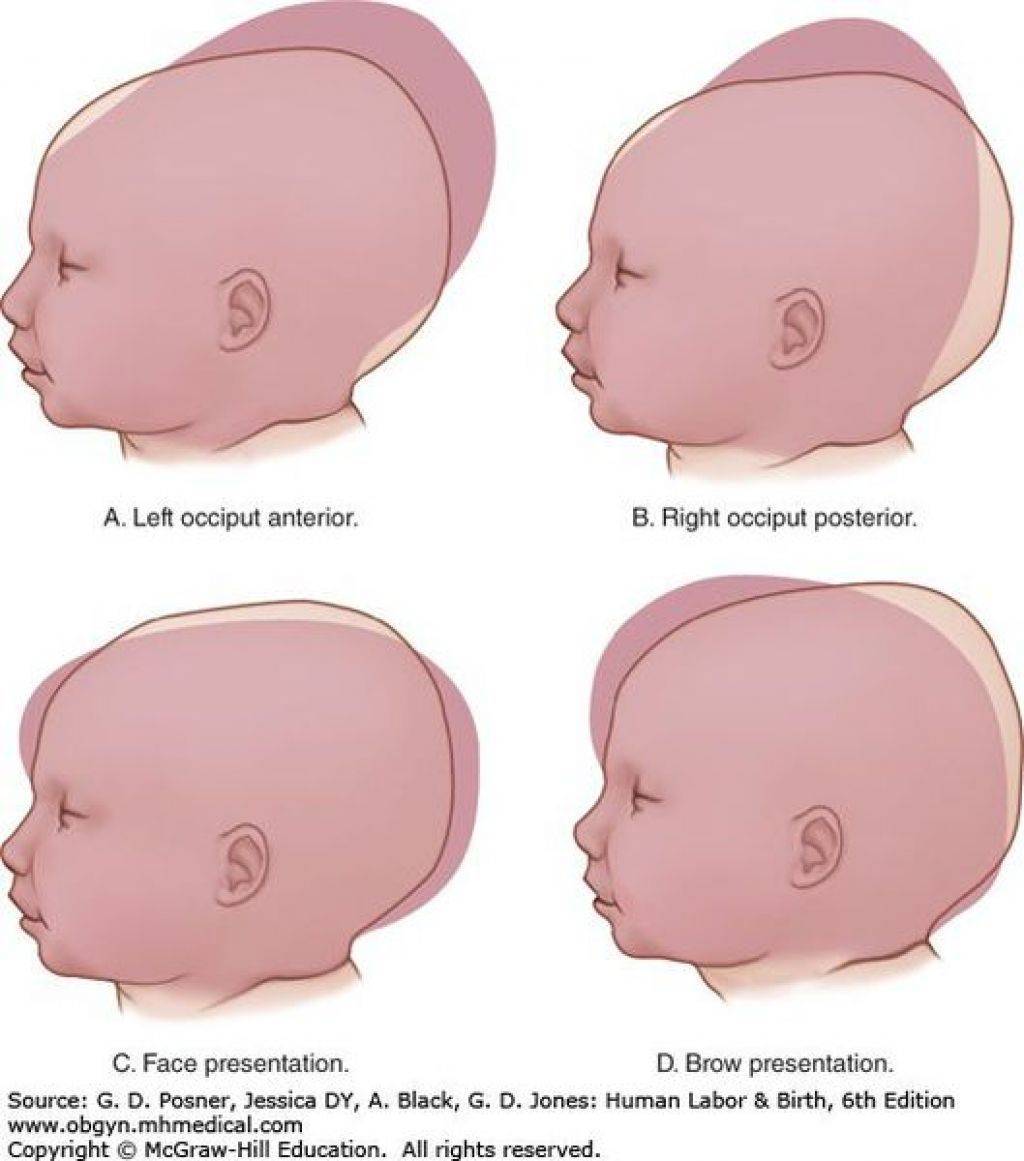 Причины и последствия кефалогематомы на голове у новорожденных детей, лечение и сроки рассасывания, мнение комаровского