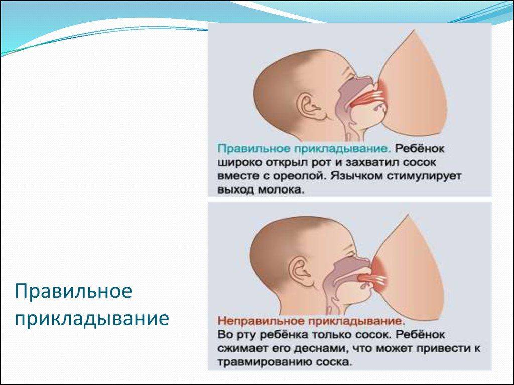 Трещины на сосках при кормлении: причины, лечение и профилактика