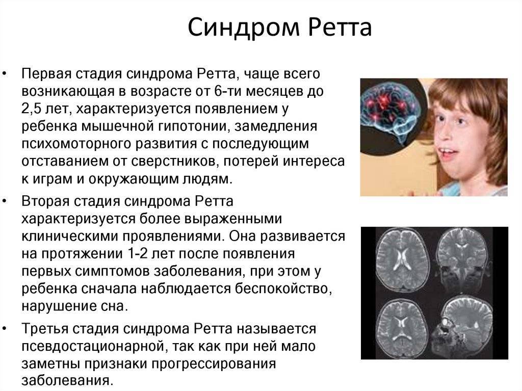 Синдром ретта — симптомы, диагностика, лечение | планирование беременности