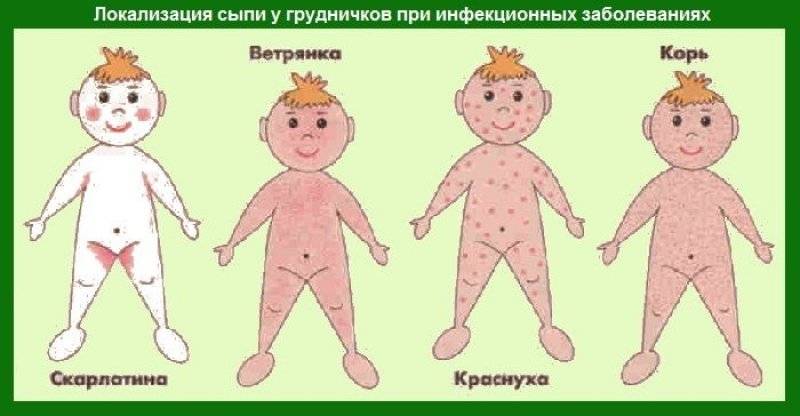 Прыщики в паху у ребенка: причины, лечение патологии