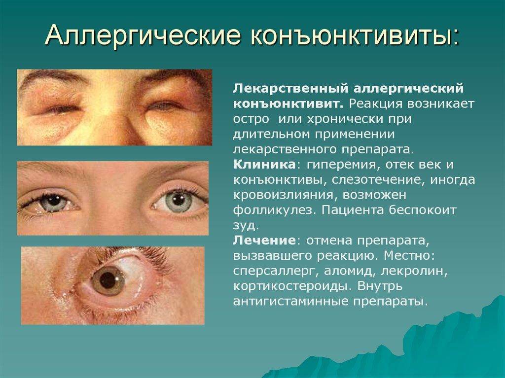 Конъюнктивит у детей