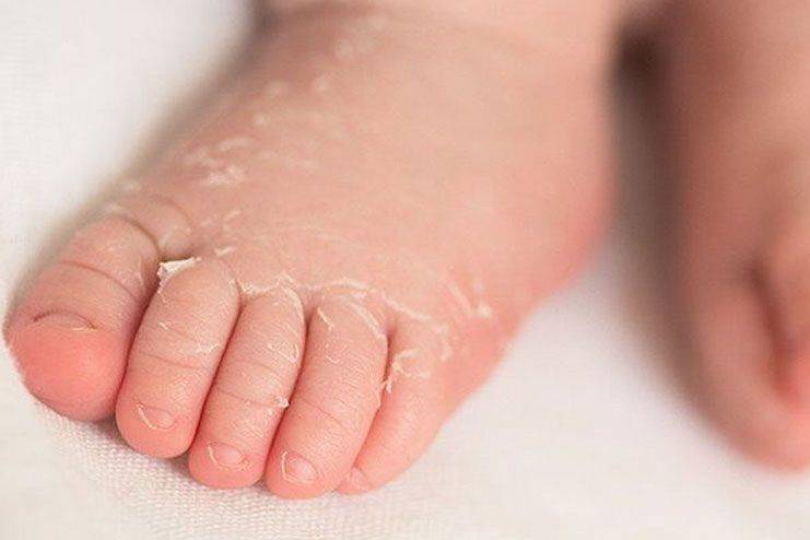 Шелушится кожа у новорожденных | уроки для мам