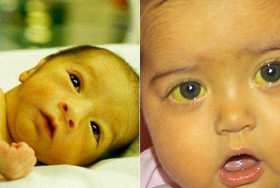 Раствор от желтушки. младенческая желтуха: симптомы, методы лечения, последствия для новорожденных