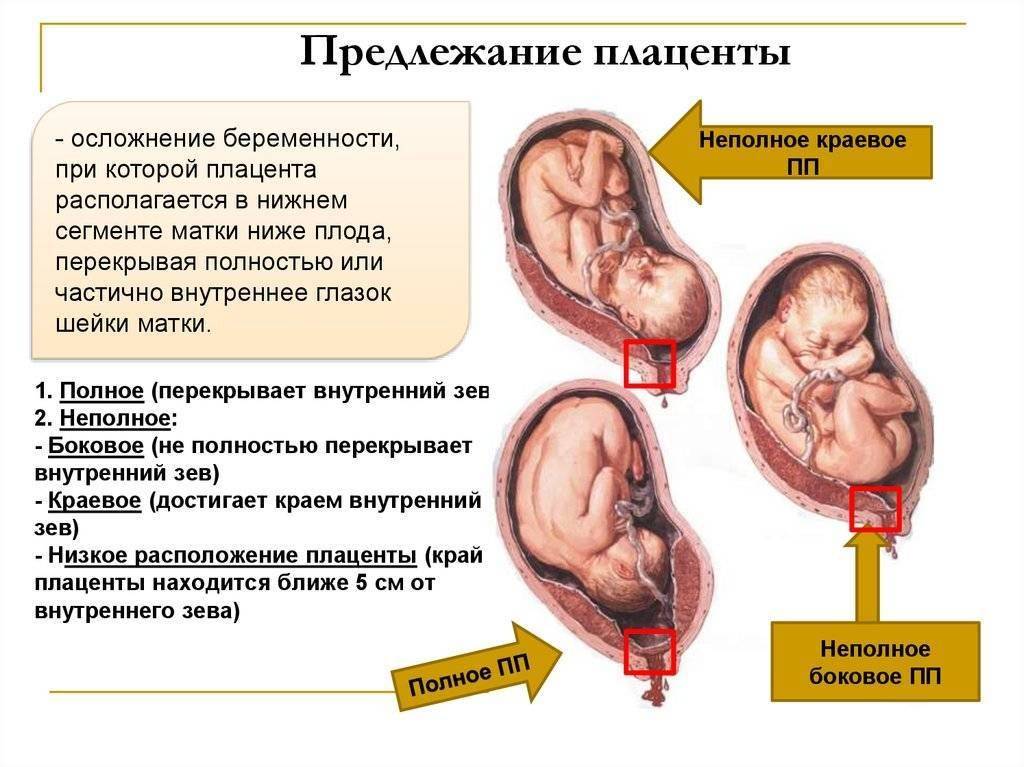 Чем опасно низкое расположение плаценты - риски для мамы и малыша + способы лечения