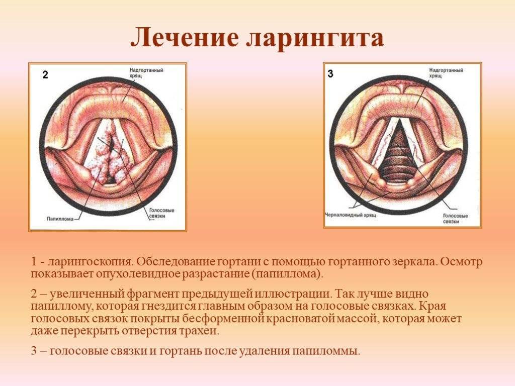 Ларингит у грудничка: симптомы и лечение