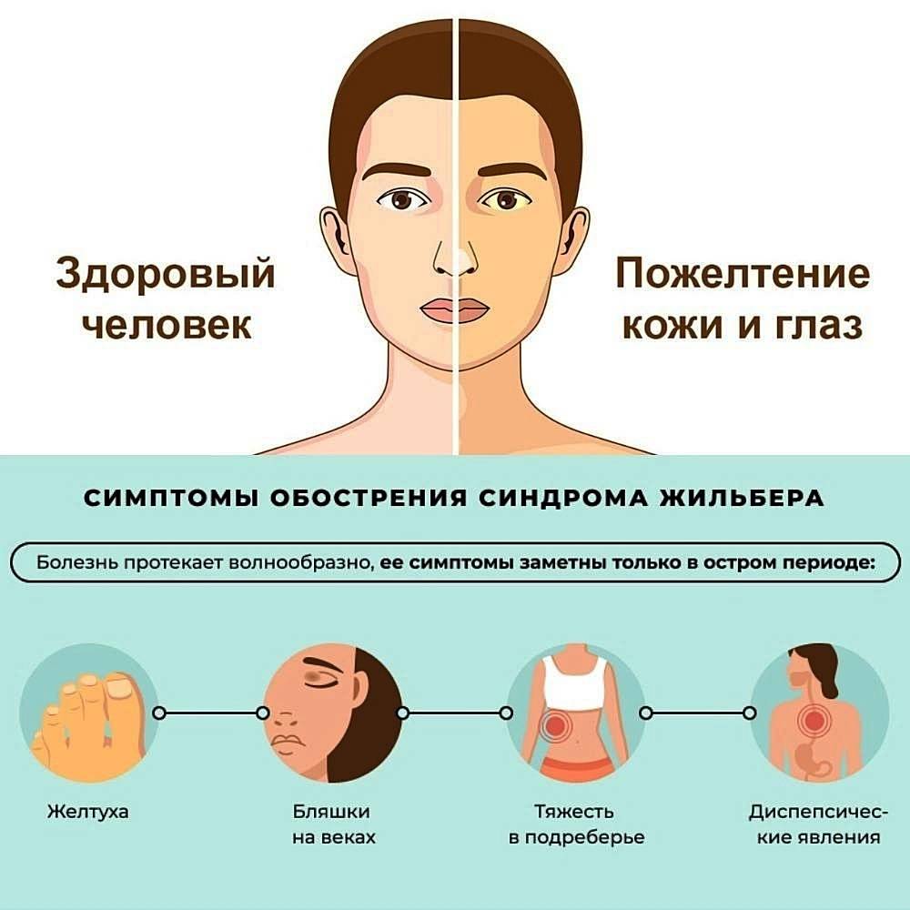 Синдром жильбера