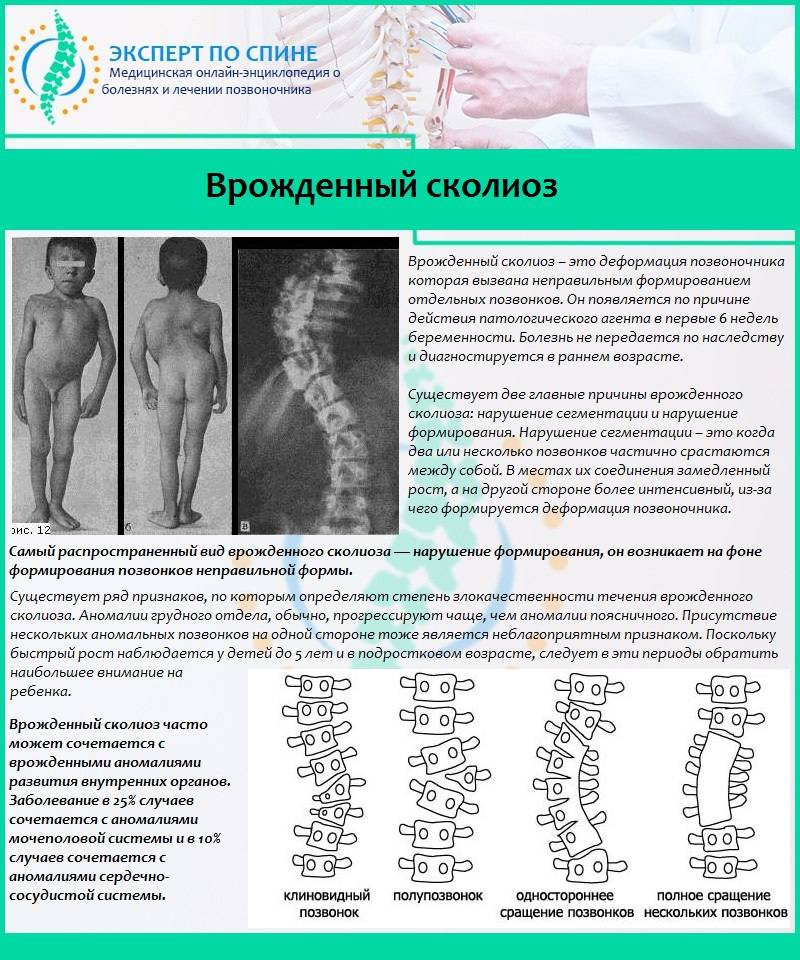 Сколиоз