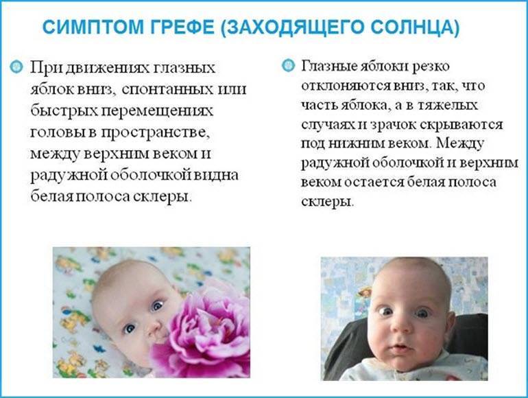 Симптом Грефе у грудничков — что это такое, причины возникновения