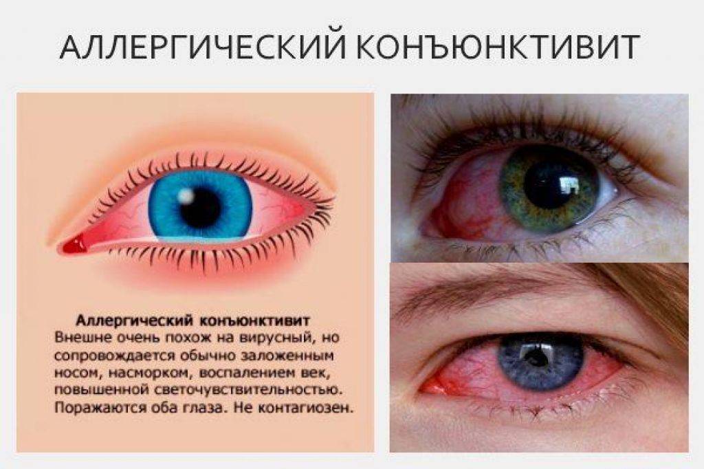 Коньюктивит у детей - виды, причины, симптомы, принципы лечения