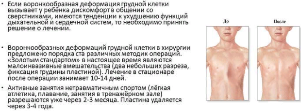 Воронкообразная деформация грудной клетки у детей и взрослых, лечение без операции