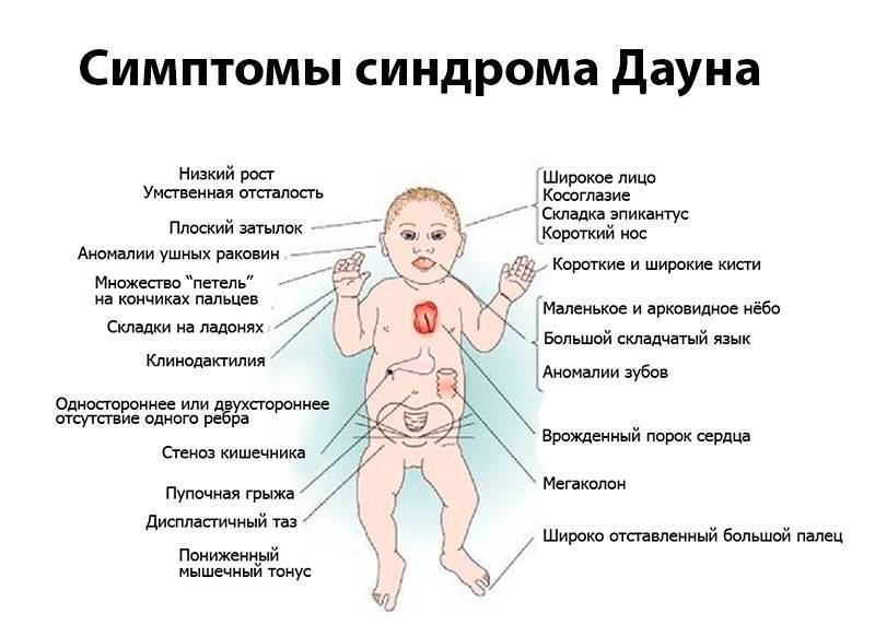 Cиндром патау