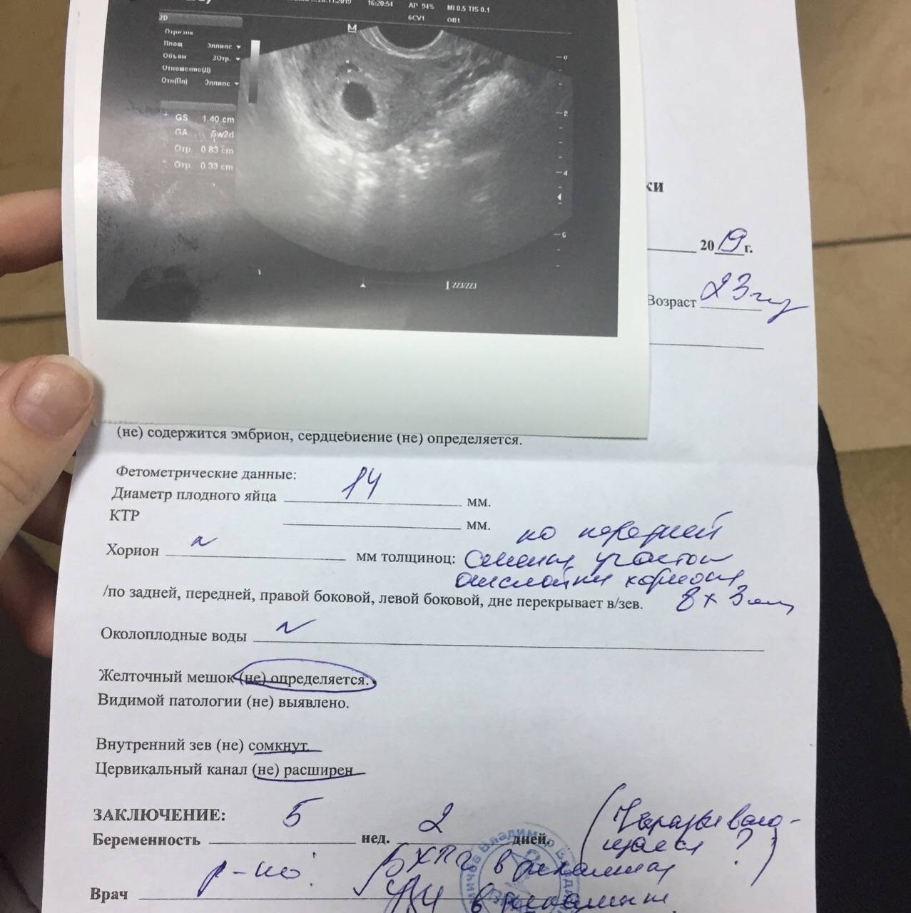 Не видно эмбрион на 5 неделе беременности