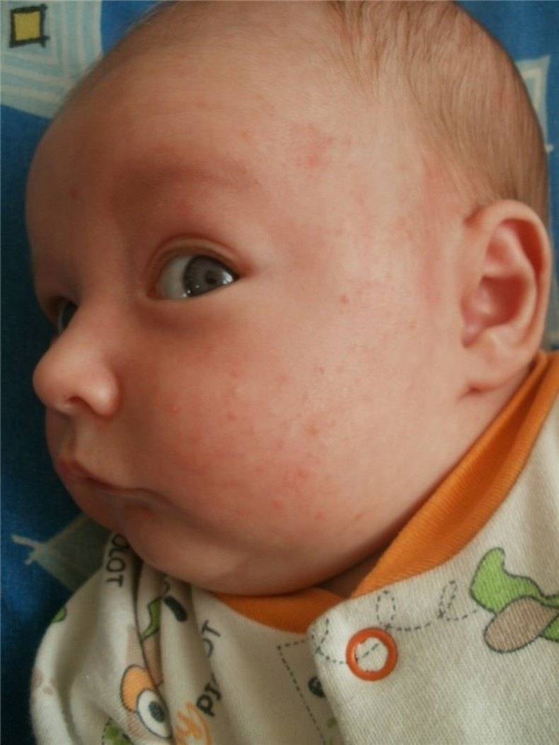 Есть ли аллергия на гречку. Атопический дерматит у детей сыпь. Атопический дерматит у новорожденного. Атопический дерматит на щечках у грудничка. Гнейс атопический дерматит.