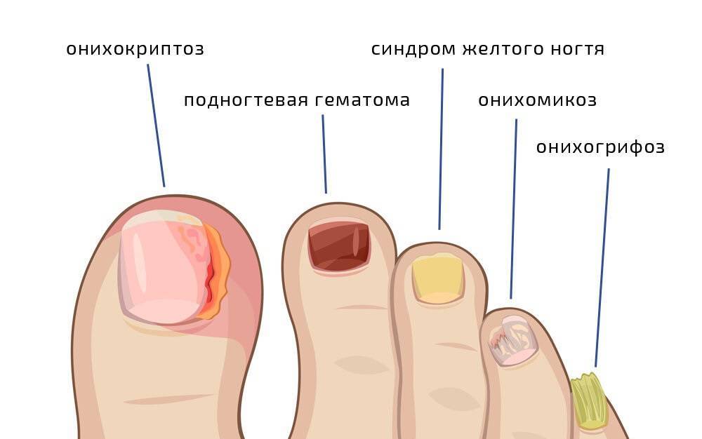 Онихокриптоз у грудничка: почему возникает и как лечить вросший ноготь?