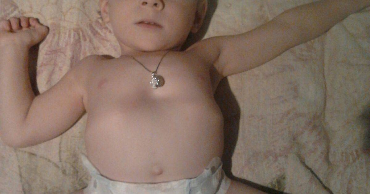 Впалая грудная клетка: причины вогнутой груди у мужчин и женщин, ямка в грудной клетке у грудничка, упражнения | ревматолог | zaslonovgrad.ru