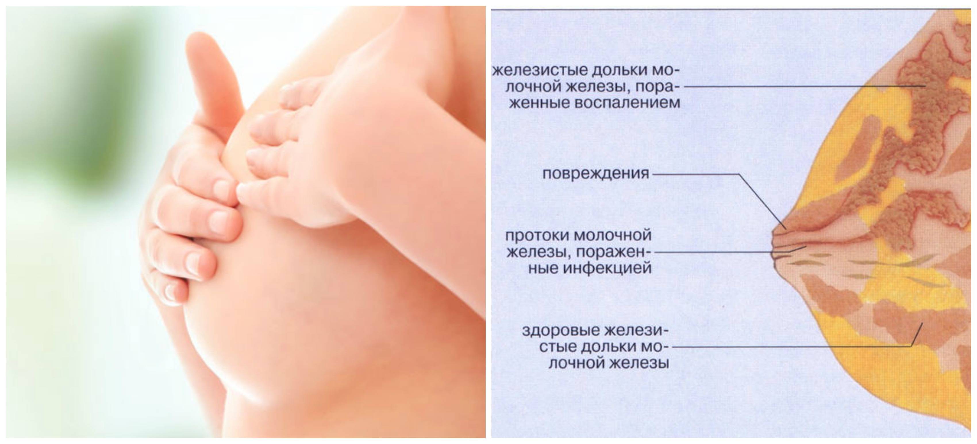 Причины боли при лактации