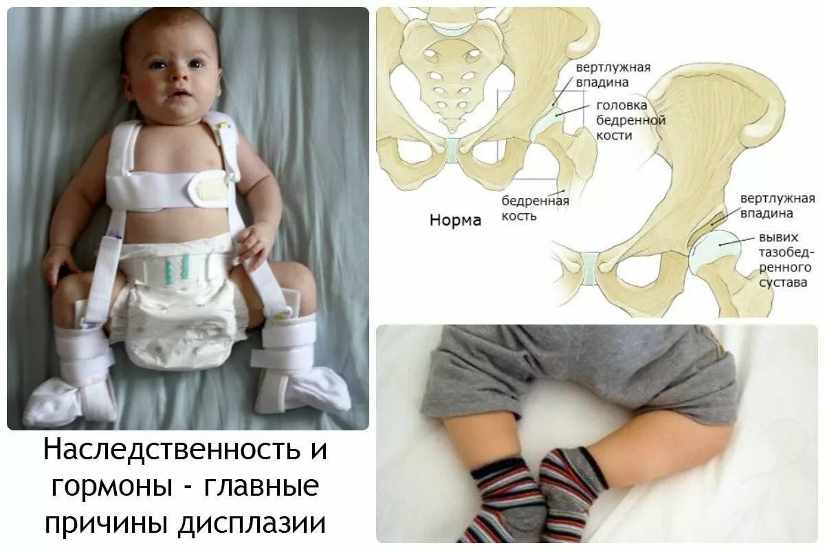 Дисплазия тазобедренных суставов у новорожденных, признаки у грудничков