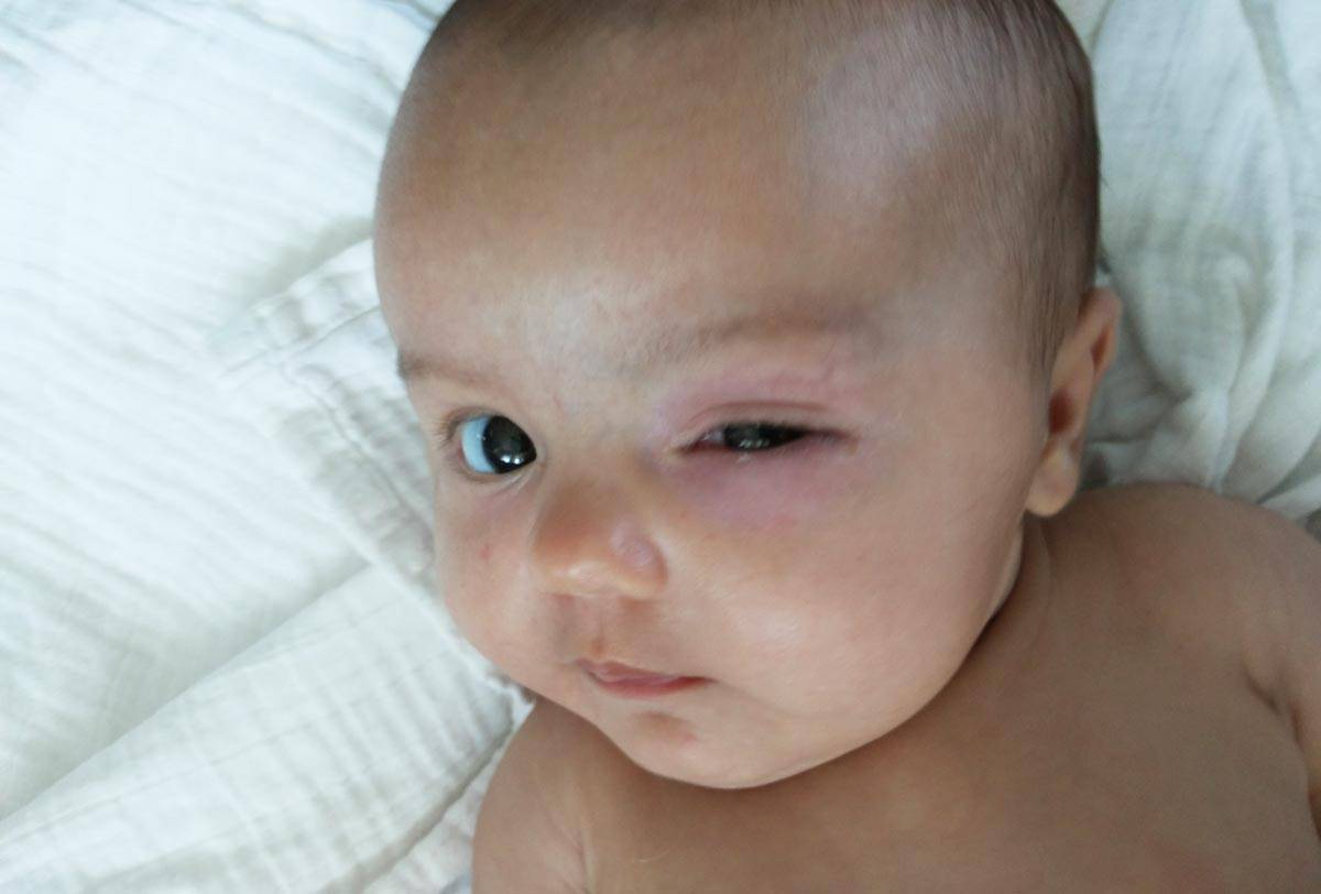 У новорожденного гноится глазик: что делать, чем и как лечить глазки грудничков, профилактика заболевания
