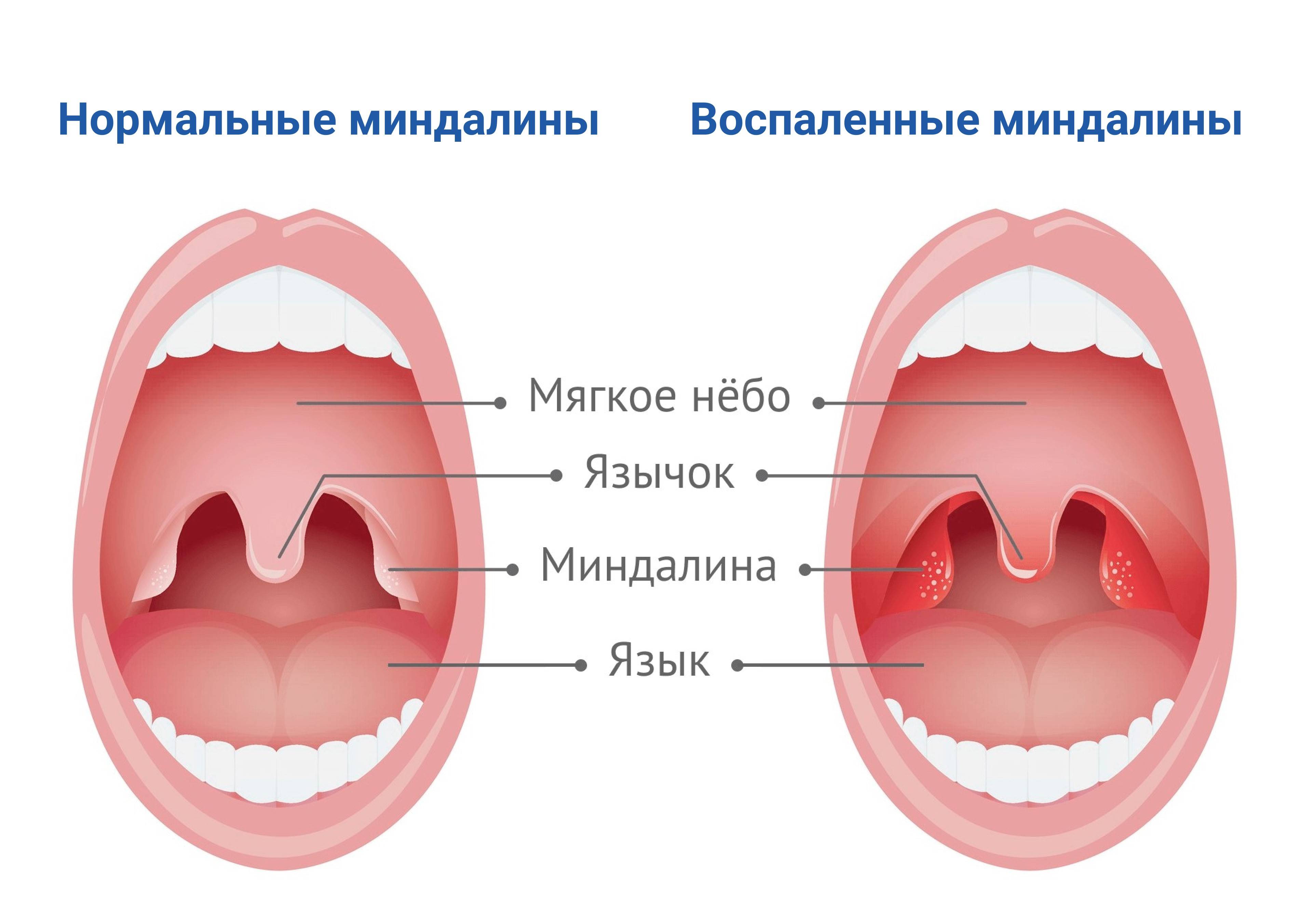 Больно Глотать Какое Лекарство Купить