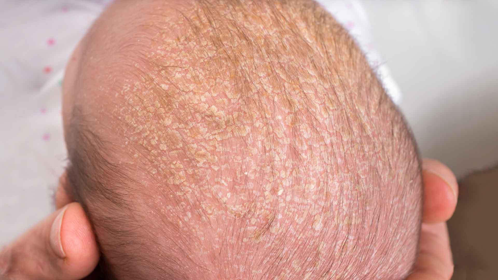 Что делать при шелушении кожи у новорожденного