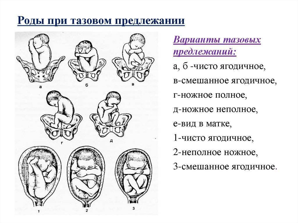 Положение плода 38. Головное ножное предлежание плода. Положение продольное предлежание тазовое ягодичное 2 позиция. Положение плода продольное тазовое 2 позиция. Тазовое предлежание позиция 1 вид.