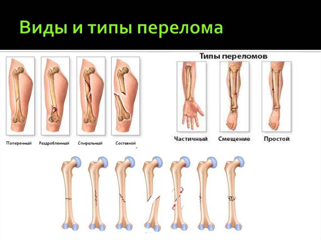Перелом кости может быть каким. Виды переломов костей конечностей классификация. Классификация переломов по характеру повреждения кости. Виды перьев. Типы закрытых переломов.